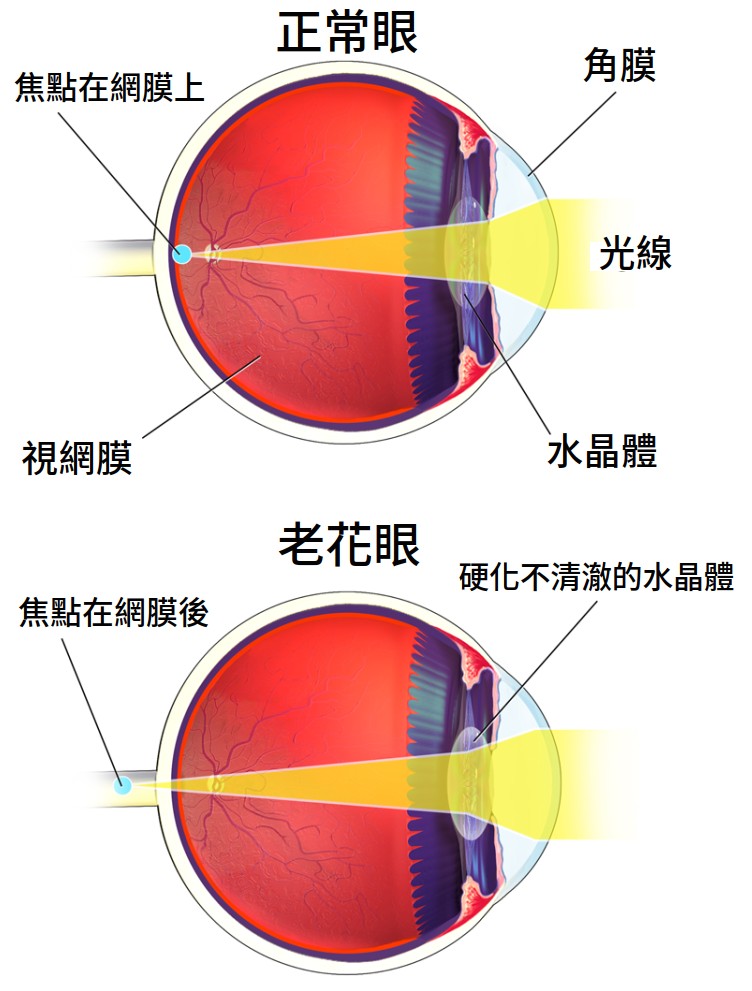 老花眼對焦在網膜後